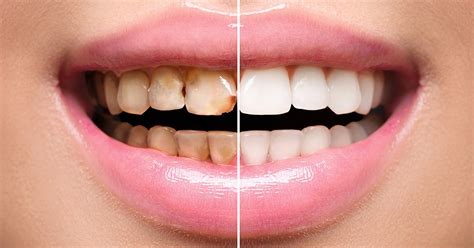 What Are Dental Veneers? Everything to Know About Cosmetic Dentistry