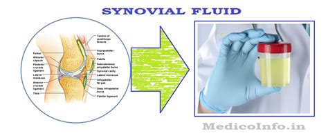 Synovial Fluid Collection & Analysis : Significance, Collection, Patient preparation ...