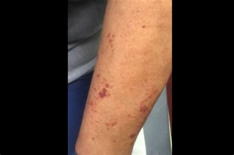 Derm Dx: Dark Spots on the Arms - Dermatology Advisor