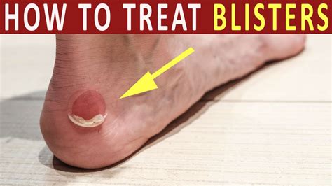How To Get Rid Of A Foot Blister - Numberimprovement23