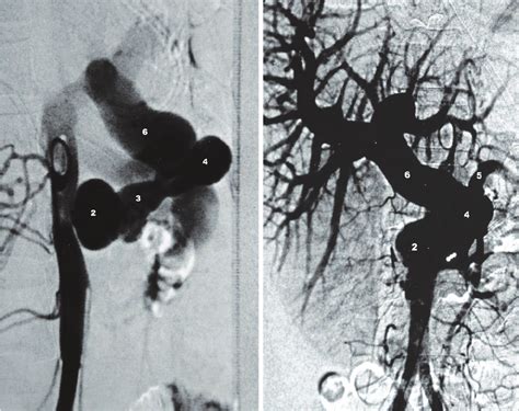 Abdominal aortogram, catheter tip at L1 vertebral level - (a) lateral,... | Download Scientific ...