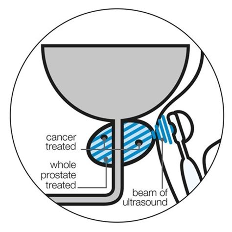 PROSTATE CANCER FOCAL THERAPY - PROSTATE HIFU TECHNIQUE ...