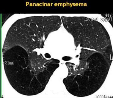 肺气肿成像:实践要点，放射学，计算机断层摄影