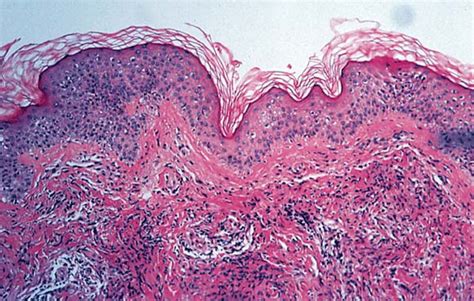 The spectrum of cutaneous disease in multiple myeloma - Journal of the ...