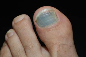 Causes & Symptoms of Black Toenails | Dallas Podiatry Works