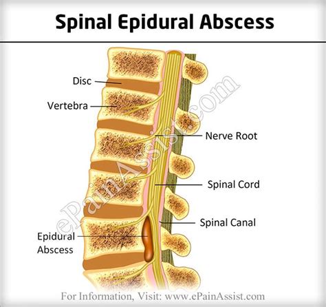 Epidural Abscess: Treatment, Prognosis, Pathophysiology, Symptoms (With images) | Epidural ...