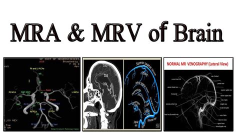 MRA & MRV of Brain - YouTube