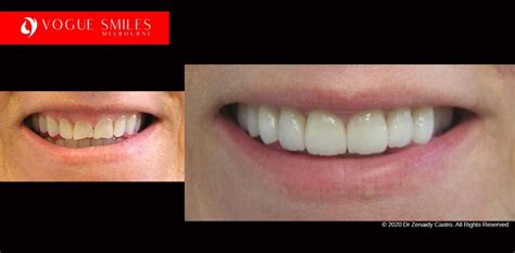 Full Mouth Reconstruction Before and After Melbourne CBD