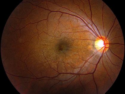 Macular Edema: Causes, Symptoms, Treatment | OBN