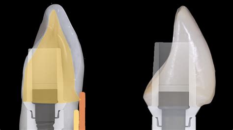 Nobel Biocare Implant for Single Tooth Replacement - rezotto production