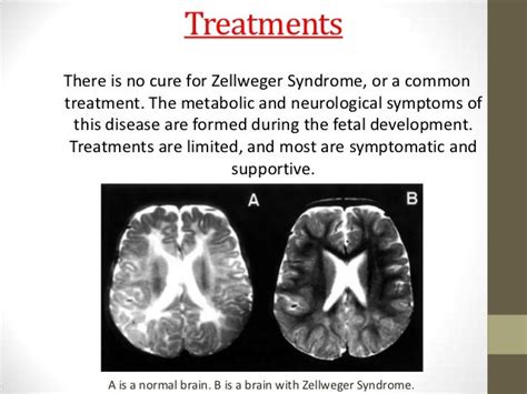 Zellweger syndrome