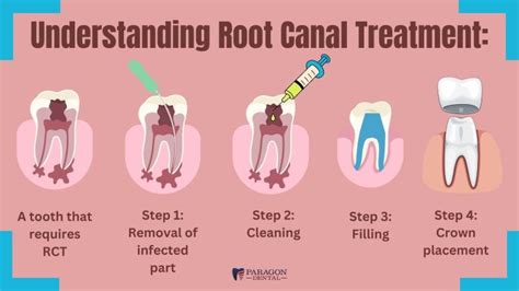 The Importance of Dental Crown After Root Canal Treatment - TheOmniBuzz