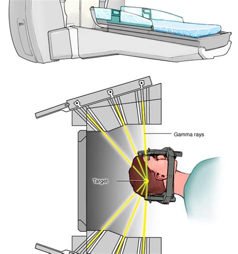 Stereotactic radiosurgery — MATLAB Number ONE