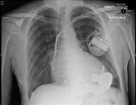 Overview of Left Ventricular Assist Devices (LVADs) - ED ECMO