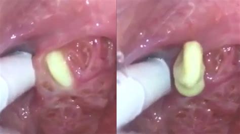 Tonsil Stone Removal - YouTube