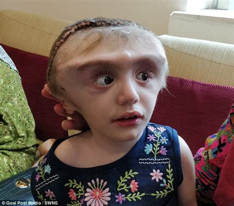 Tajikistan girl with 28-inch head caused by deadly build-up of fluid | Daily Mail Online