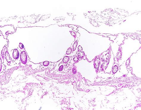 Pathology Outlines - Pneumatosis cystoides intestinalis