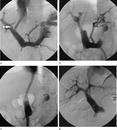 Intravascular Ultrasound–guided Direct Intrahepatic Portacaval Shunt ...