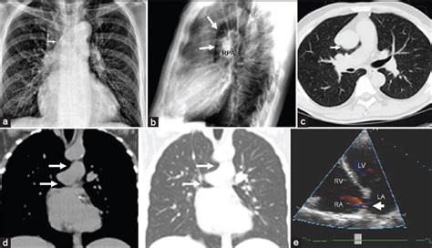 Congenital Absence of the Right Pericardium: Embryology and Imaging - Journal of Clinical ...