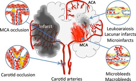 What is Vascular Dementia Symptoms, Causes, Stages & Life Expectancy