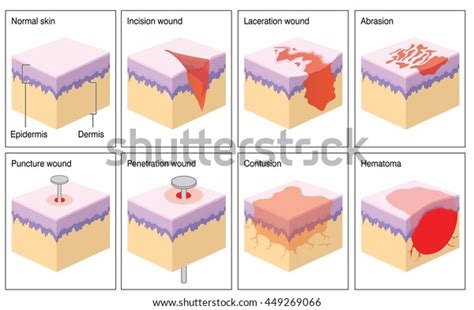 Various Types Skin Wound Stock Illustration 449269066