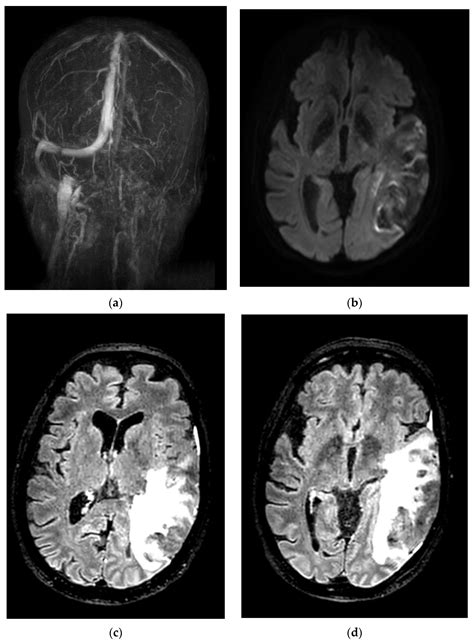 Causes Of Cavernous Sinus Thrombosis