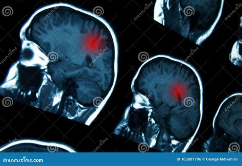 MRI brain scan stock photo. Image of problem, imaging - 103801796