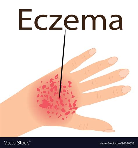 Eczema affected a hand dermatology skin disease Vector Image