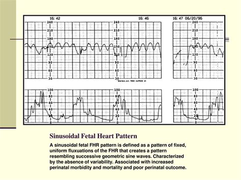 Sinusoidal fetal heart rate