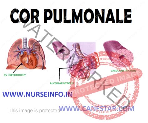 COR PULMONALE - Nurse Info