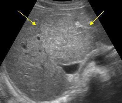 Abdomen and retroperitoneum | 1.1 Liver : Case 1.1.1 Focal nodular ...