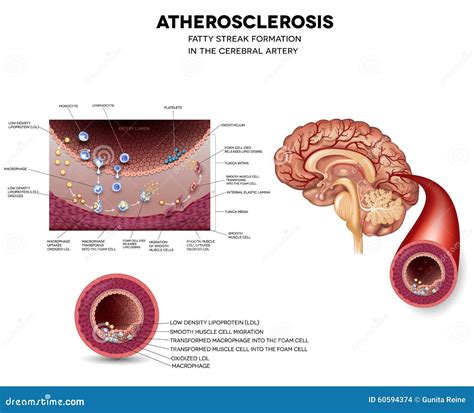 Fatty Streak Formation In The Brain Artery Stock Vector - Image: 60594374