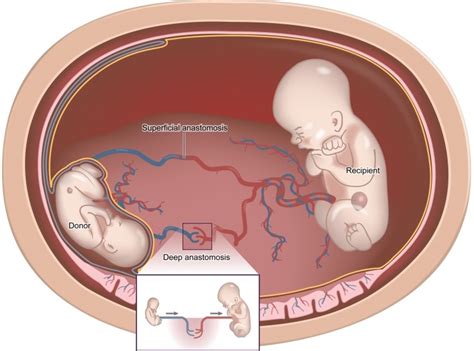 fetal transfusion syndrome, Kliegman: Nelson Textbook of Pediatrics ...