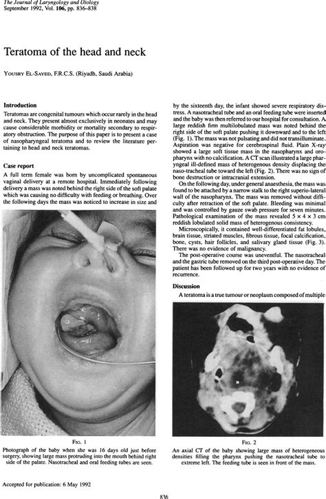 Teratoma of the head and neck | The Journal of Laryngology & Otology ...