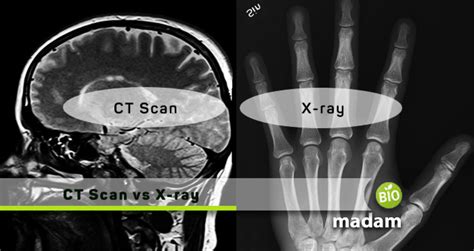 Difference Between CT Scan and X-ray - biomadam