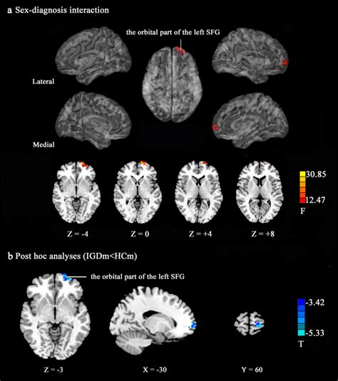 ALFF results: A: Sex-diagnosis interaction effect on the ALFF maps: A ...