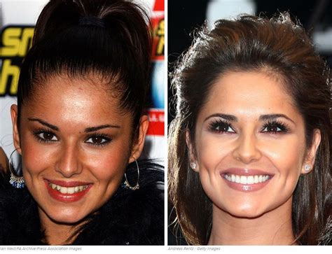 16 best Hollywood Dental Makeover images on Pinterest | Celebrity smiles, Plastic surgery and ...