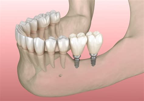 Mini Dental Implants Hackettstown | Skylands Dental of New Jersey