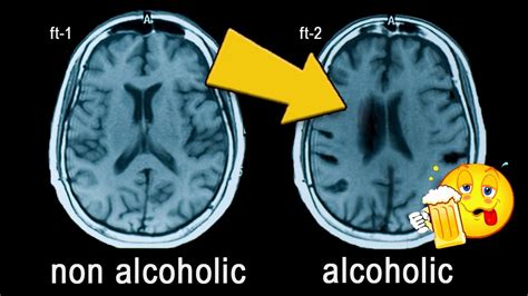 What Alcohol Consumption Does To Your Brain – Collective Evolution