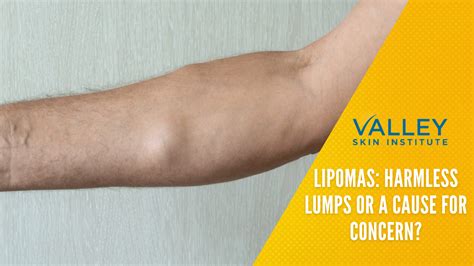 Lipomas: Causes, Symptoms, Diagnosis, and Treatment