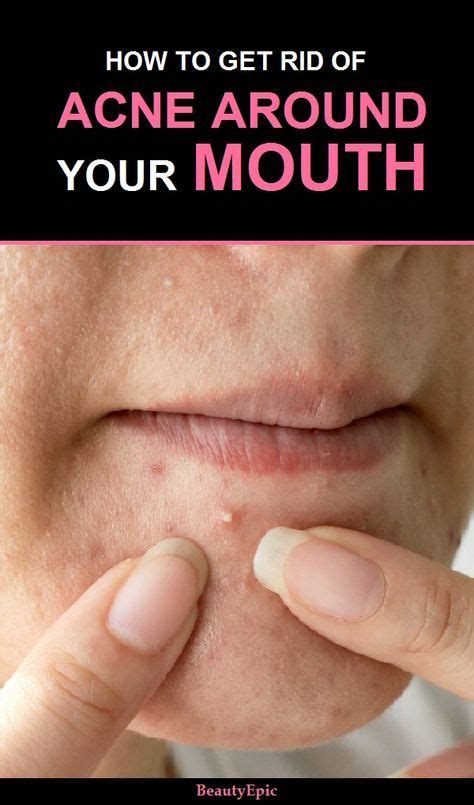 How to Get Rid of Acne Around Mouth? | How to get rid of acne, Home remedies for acne, Acne remedies