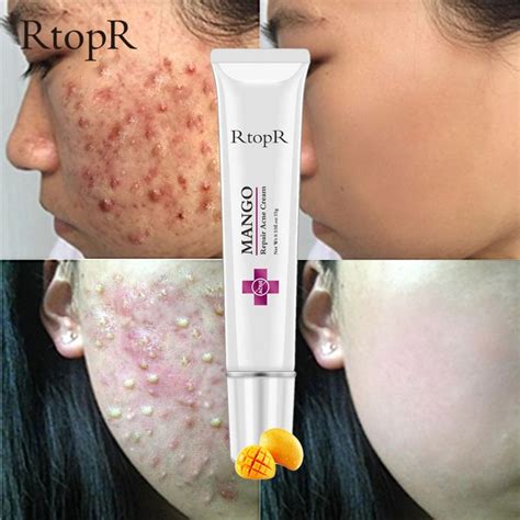 RtopR Acne Treatment Anti Acne Cream Scar Removal Cream @ Best Price Online | Jumia Kenya