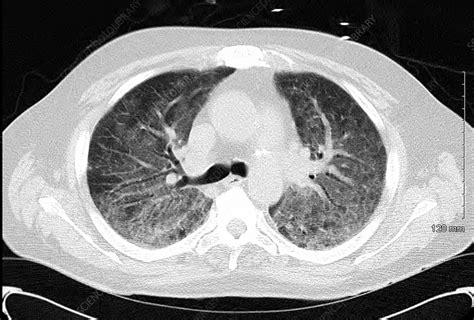 Viral pneumonia, CT scan - Stock Image C036/6389 - Science Photo Library