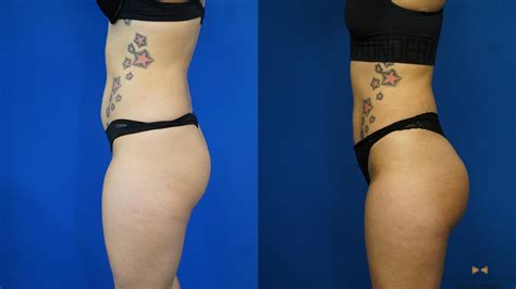 Before and After Pictures of Brazilian Butt Lift - Houston, TX Patch