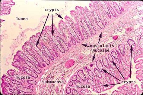 large intestine | pathology | Pinterest