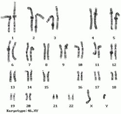 Fragile X Syndrome Karyotype