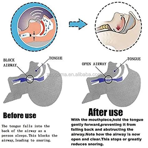 Silicone Snore Stop