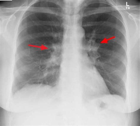 Right Hilar Lymph Node Enlargement, Location, Metastasis, Calcification