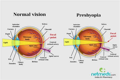 Presbyopia: Causes, Symptoms And Treatment