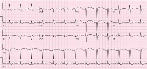 R.E.B.E.L. ECG of the Week #4 - R.E.B.E.L. EM - Emergency Medicine Blog